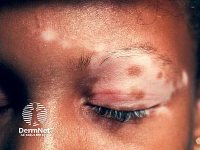 Vitiligo Disease Duration Linked to Depression Severity | Dermatology Times