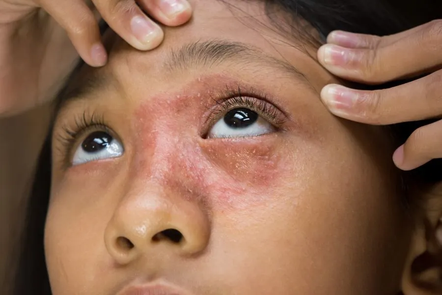La Roche-Posay reveals mental toll of eczema and scars
