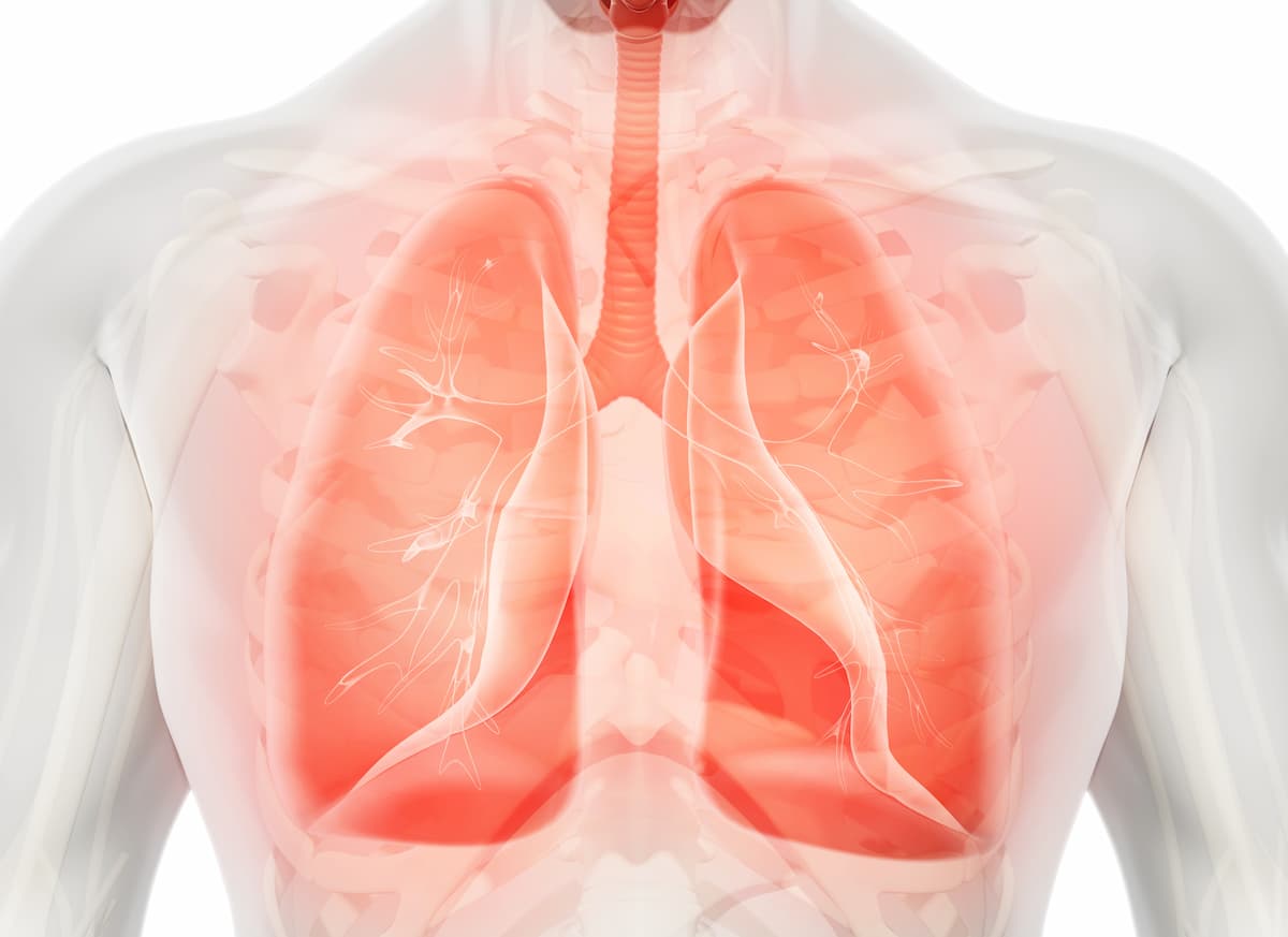 Tarlatamab Improves Survival Vs Chemotherapy in Second-Line SCLC Subgroups