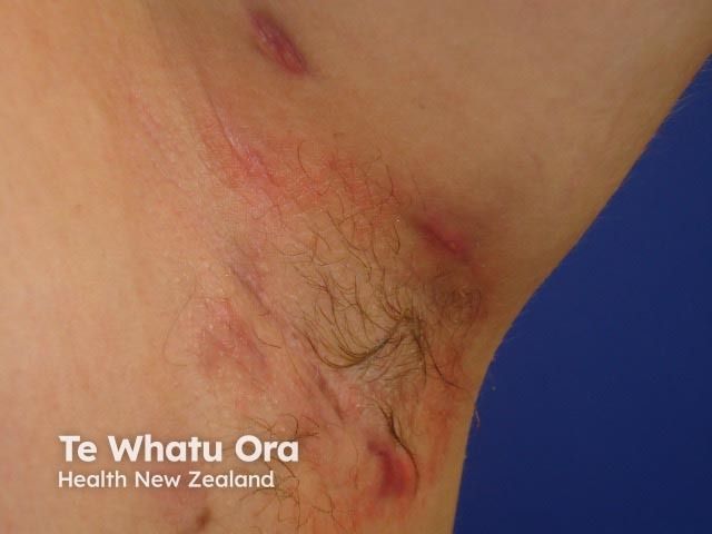 Significant Quality of Life Gains Seen After CO₂ Laser Therapy for HS