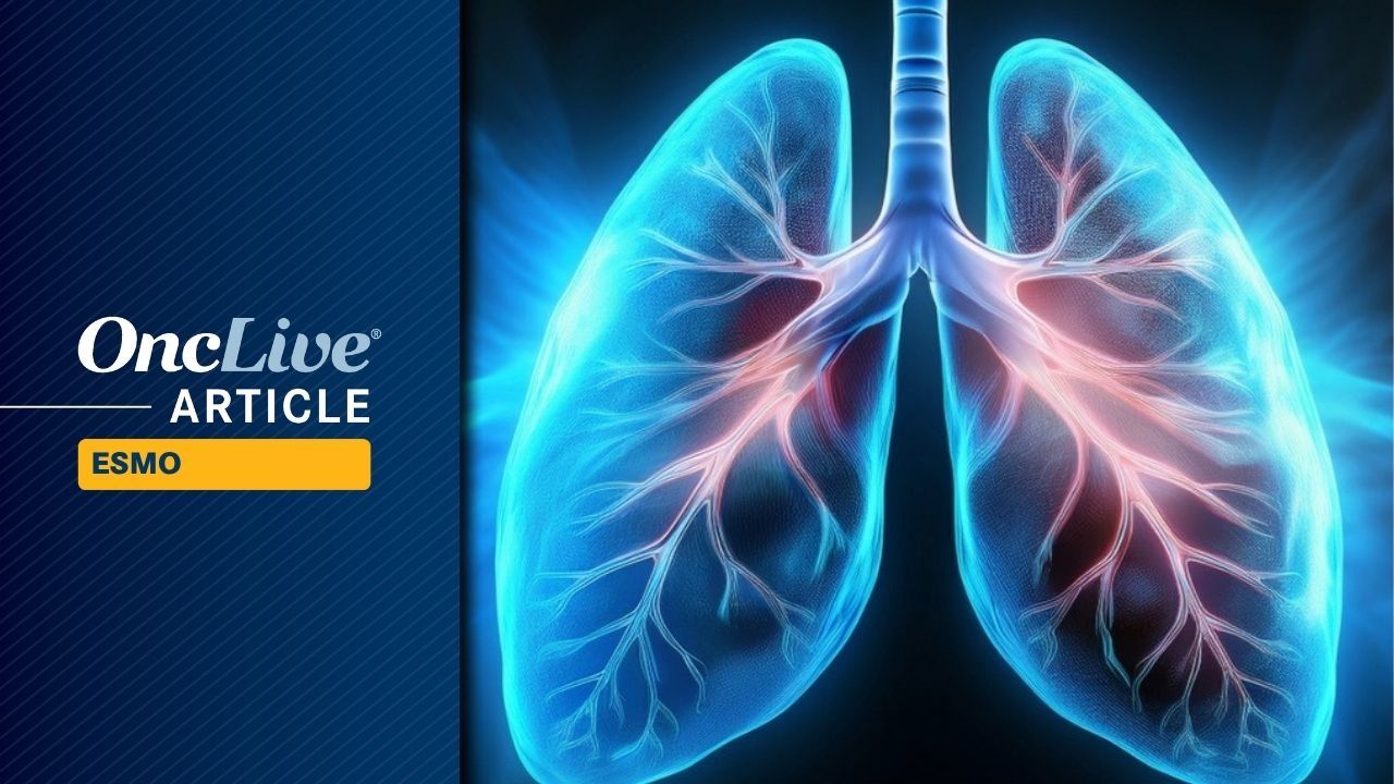 Infinatamab Deruxtecan Shows Encouraging CNS Activity in Extensive-Stage Small Cell Lung Cancer
