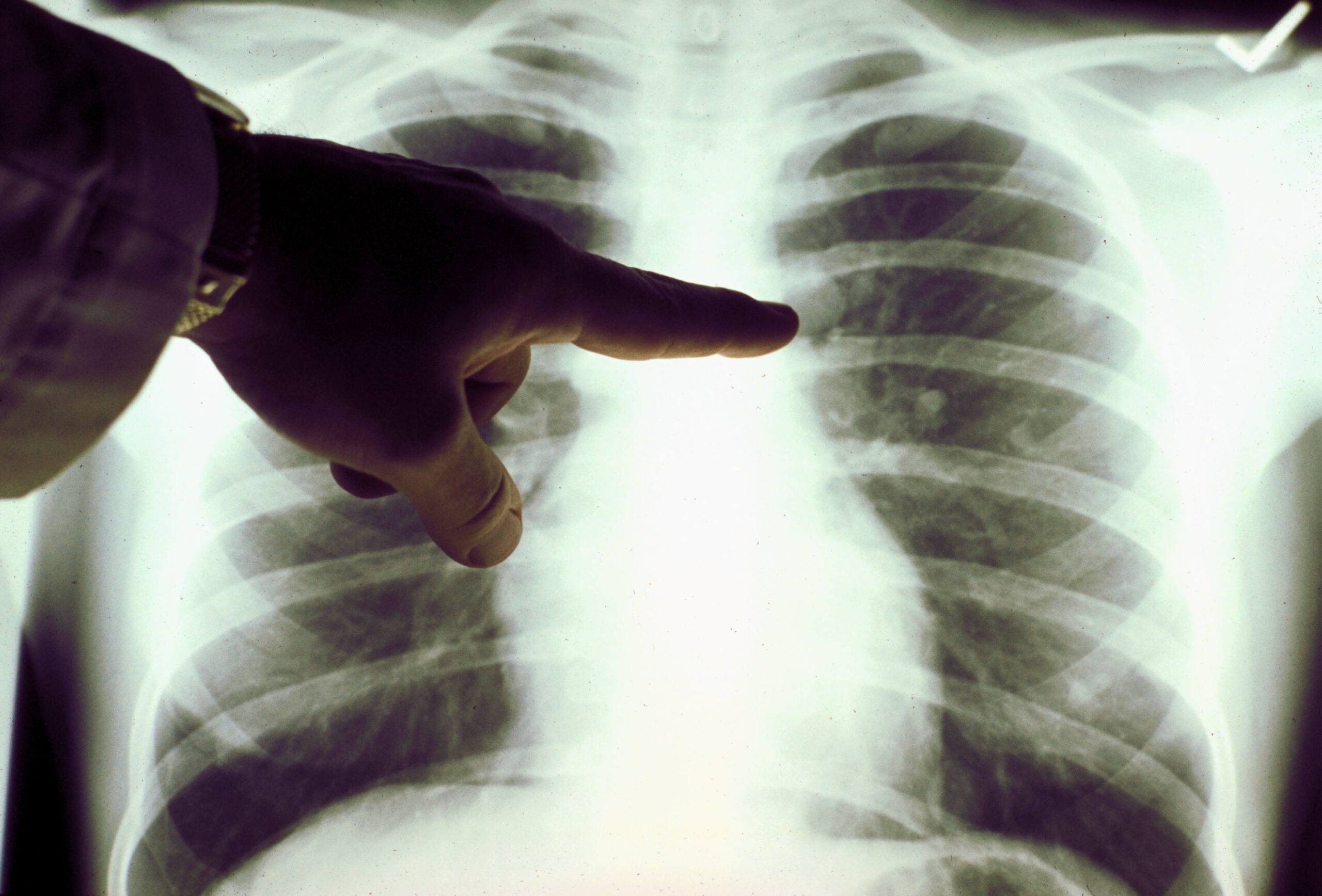 Scientists explore innovative technique for lung health improvements
