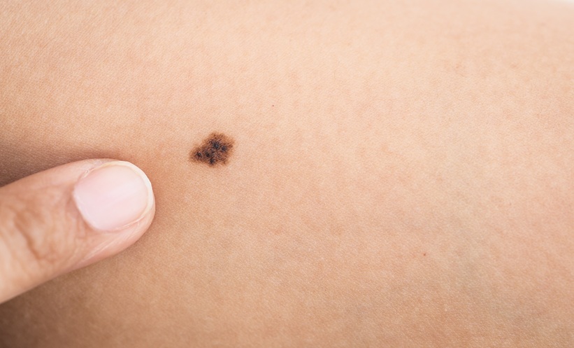 Barriers to Melanoma Diagnosis in Latino Patients