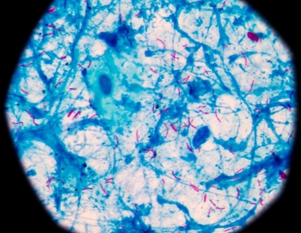 US funding cuts threaten decades of progress in pediatric tuberculosis