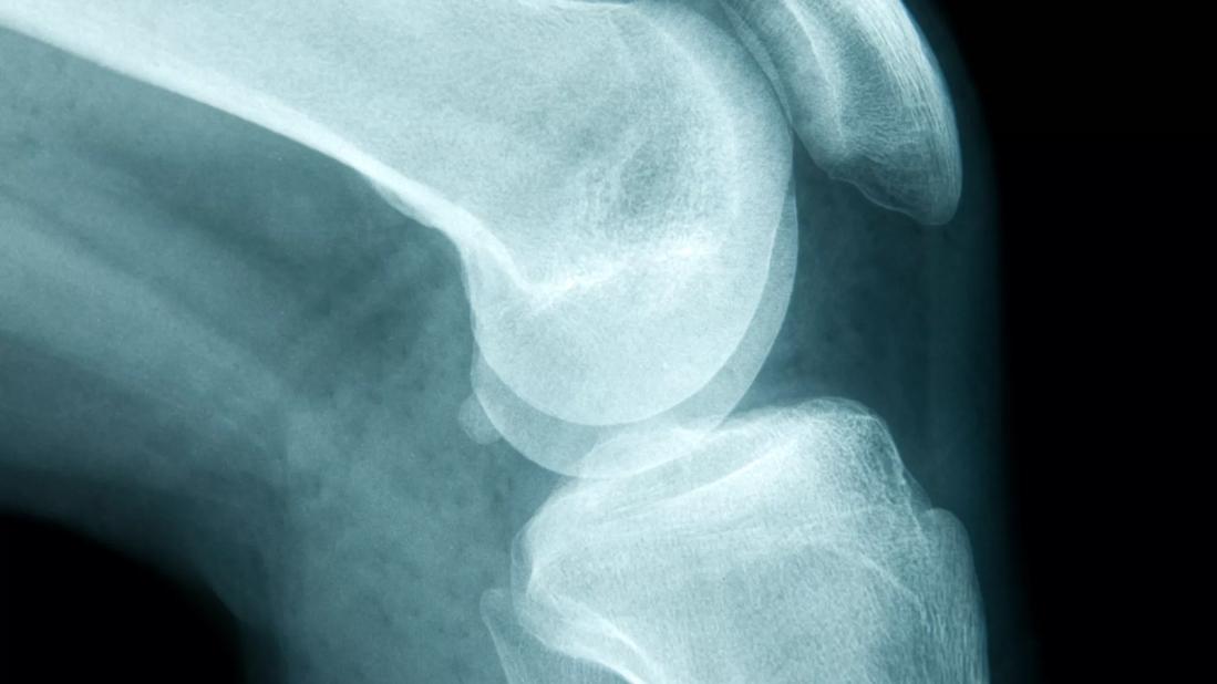 New Research Reveals Genetic Link to Most Common Pediatric Bone Cancer