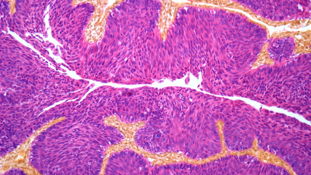 ctDNA blood test could change how cancer is treated