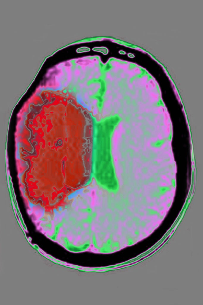 Bioxodes’ haemorrhagic stroke hopeful to progress after Phase II success