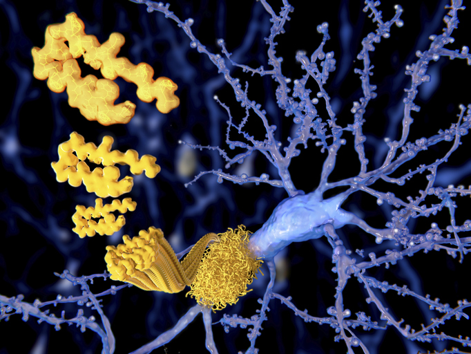 Alzheon’s Oral Alzheimer’s Drug Shows Safety and Promise for APOE4/4