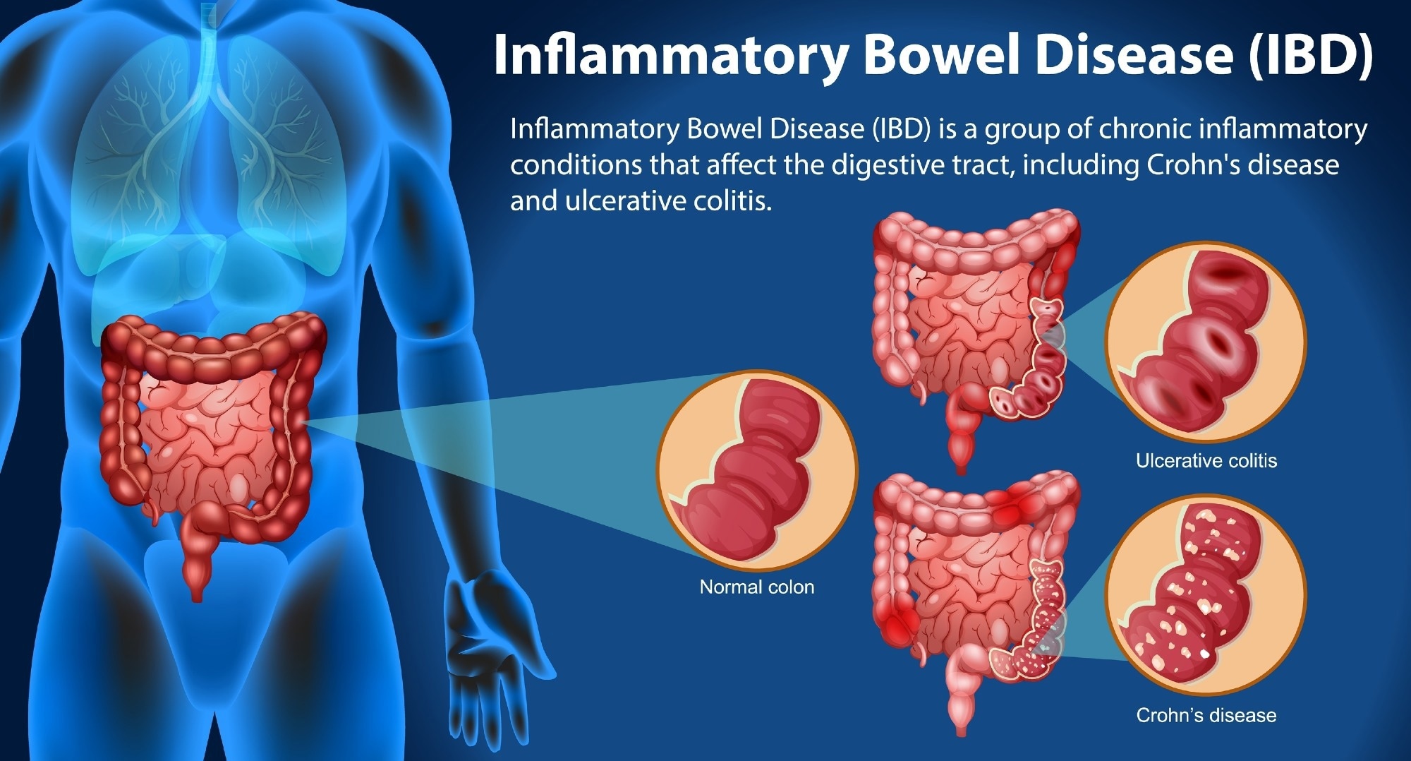 Western diet fuels IBD by derailing the microbiome