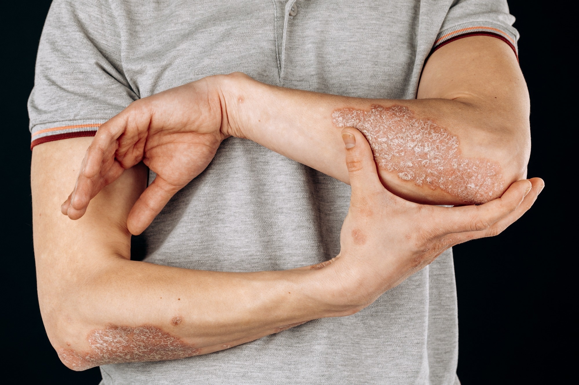 Low-calorie diets linked to higher psoriatic arthritis risk, genetic study suggests