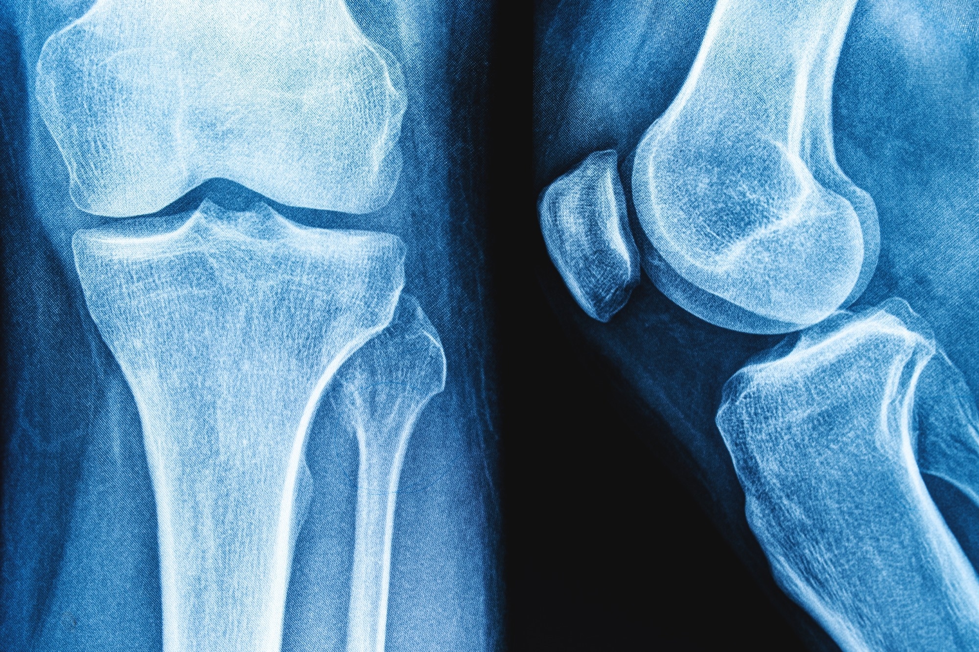 Yogurt’s impact on bone health falls short of fracture protection, review finds