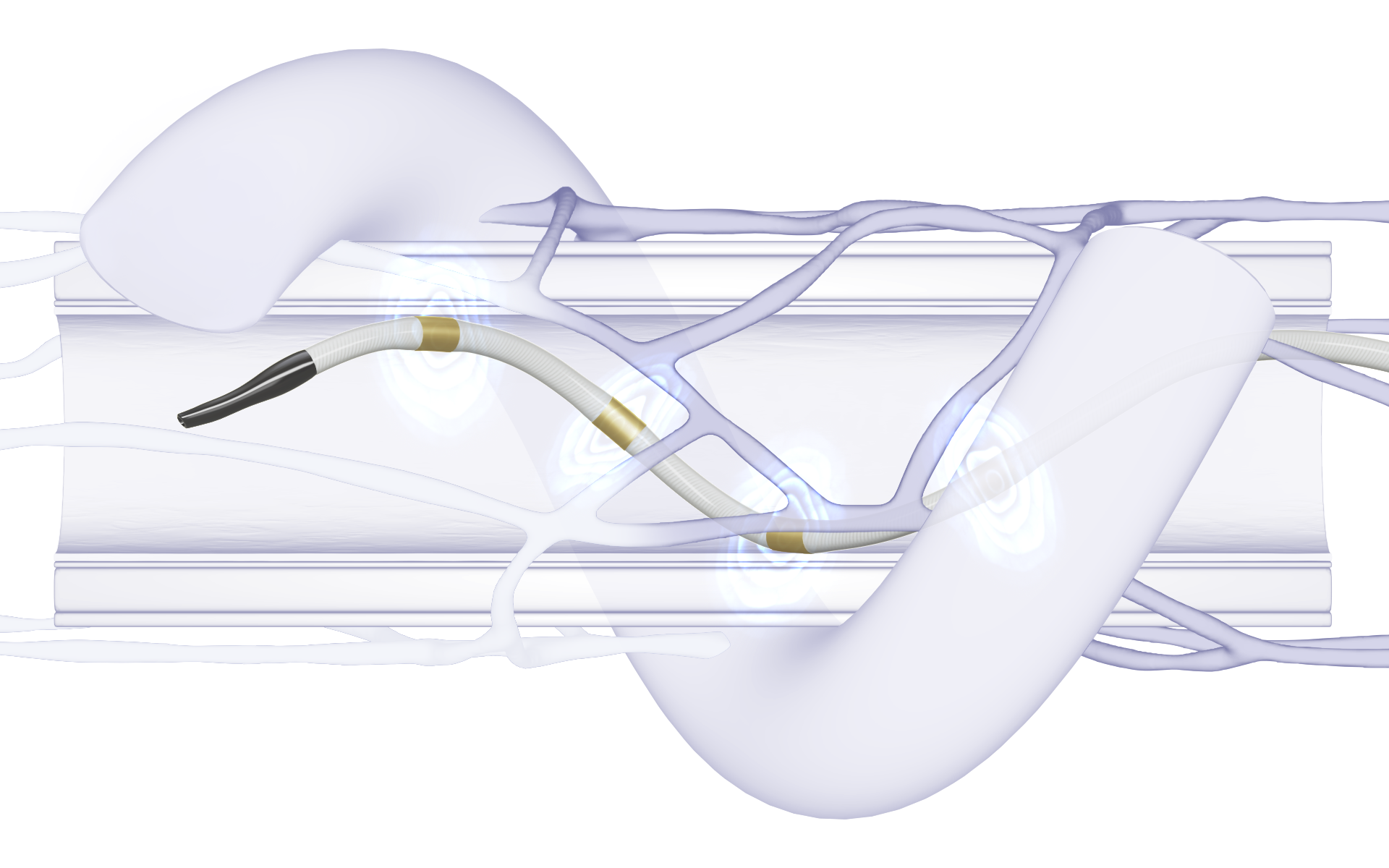 New Guidelines Support Renal Denervation for Uncontrolled Hypertension