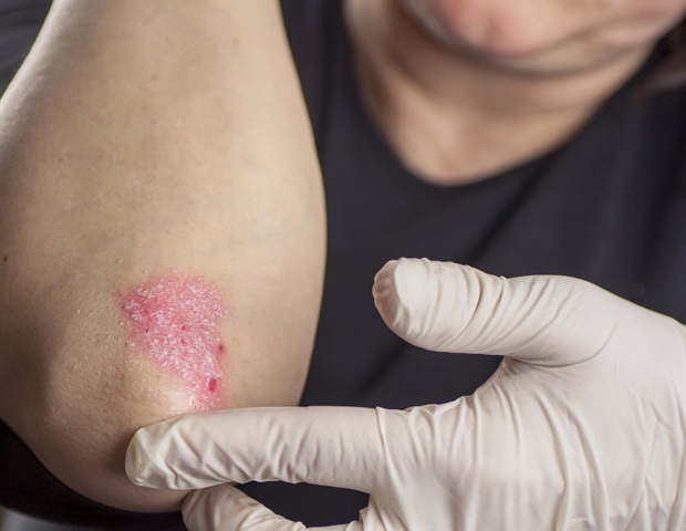 Stressful life factors early in life may triple the risk of developing psoriasis later