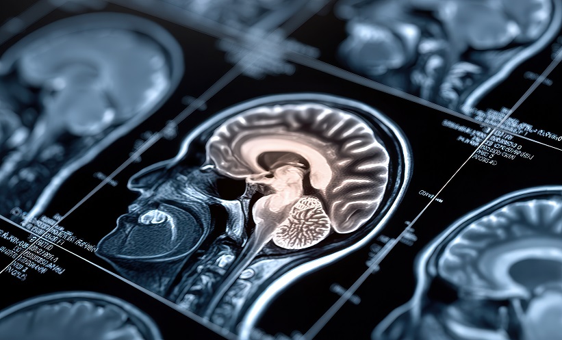 MRI Model Predicts Childhood Hormone Deficiency