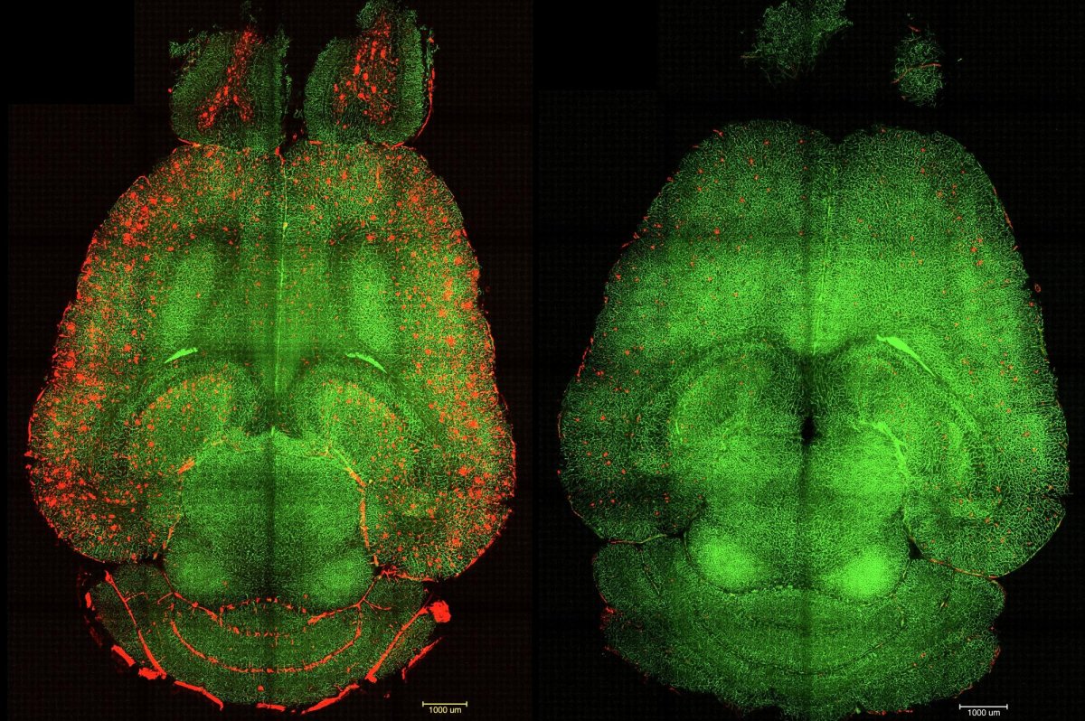 Scientists use nanoparticles to clear Alzheimer’s brain plaque in mice
