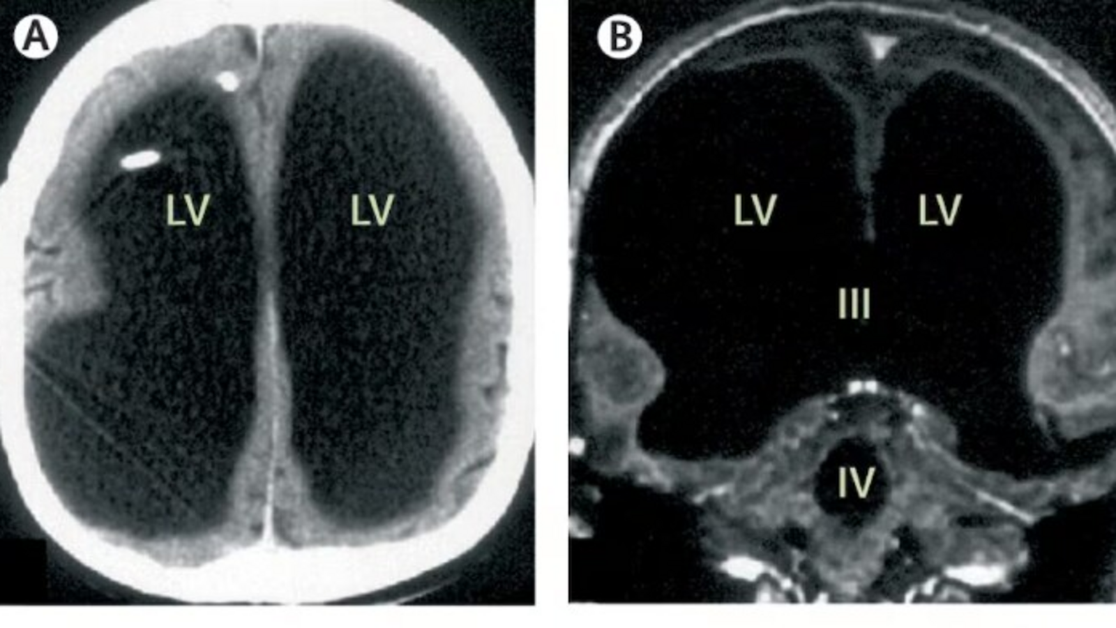 This CT scan belongs to 44 year old French man ‘who lived normal life despite missing 90% of brain’, baffled scientists