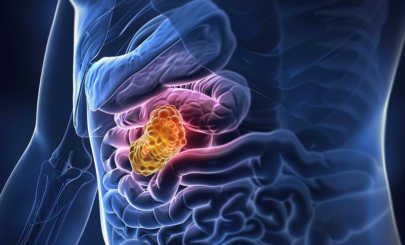 ESMO 2025: GFH375 Shows Potential Against KRAS G12D Pancreatic Tumours
