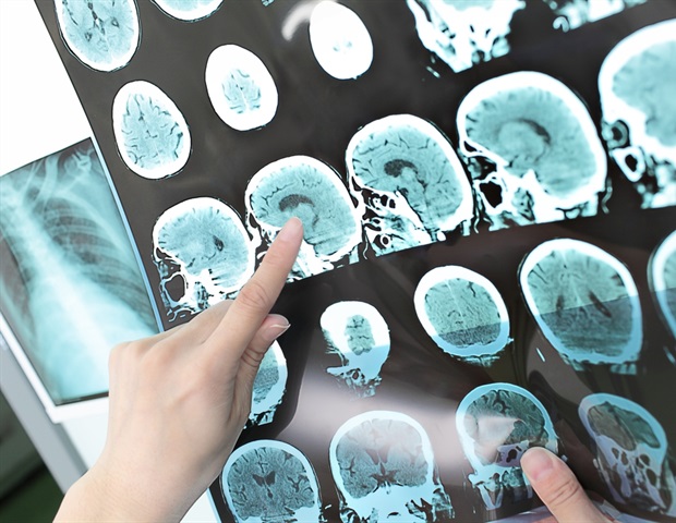 Study highlights the emotional and social challenges of stroke recovery