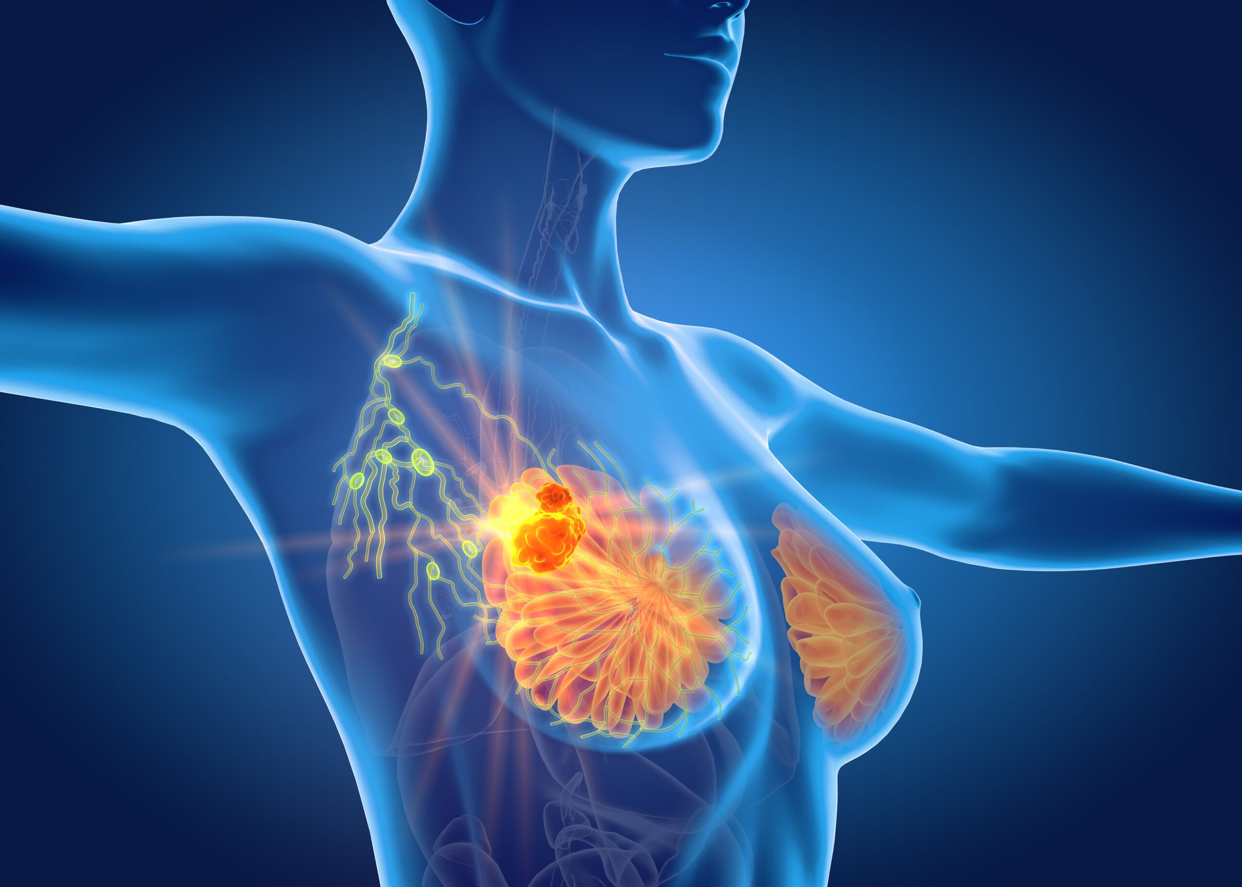 PAM Inhibition Adds Value in HR+/HER2- PIK3CA Wild Type Advanced Breast Cancer