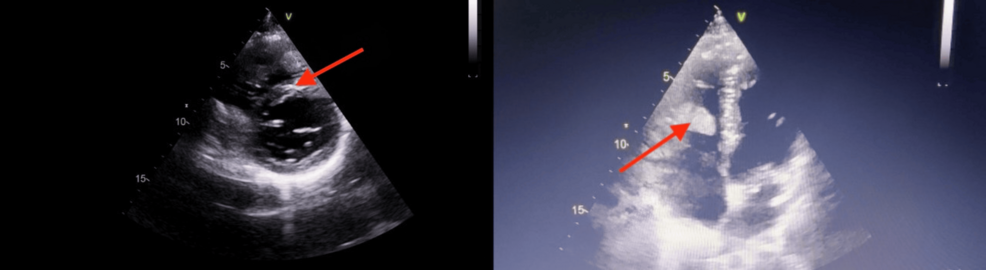 Behçet’s Disease Presenting With Large Intracavitary Thrombi and Pulmonary Embolism