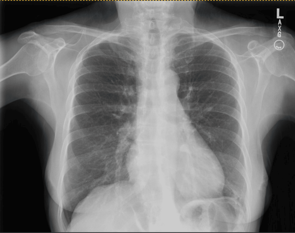Integrative Approach to Somatic (Psychogenic) Cough in a Geriatric Female Patient: A Case Study