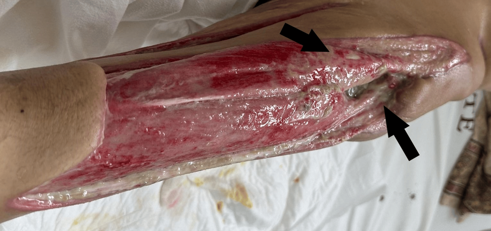 Extensive Wound Management of a Retroperitoneal Abscess Due to Complicated Pyelonephritis in a Patient With Type 2 Diabetes: A Case Report