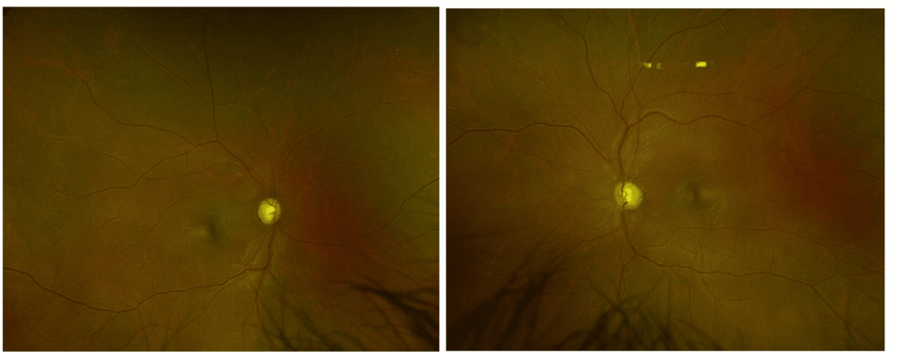 Empowering Functional Independence Through Low Vision Rehabilitation in a Patient With Chronic Kidney Disease-Related Optic Neuropathy