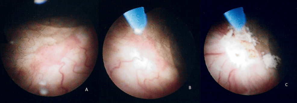 Comparative Efficacy of Transurethral Laser Ablation Versus Conventional Methods in the Management of Recurrent Non-Muscle-Invasive Bladder Tumours