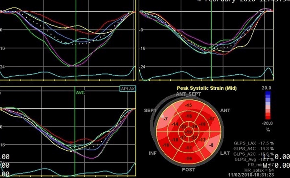 Cardiac Remodeling and Functional Alterations in Heart Failure With Preserved Ejection Fraction (HFpEF): An Echocardiographic Assessment at a Tertiary Hospital in Bangladesh