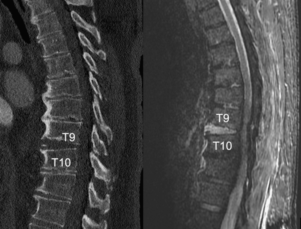 Percutaneous Versus Open Management of Thoracic and Lumbar Hyperostotic Fractures: A Case-Control Study