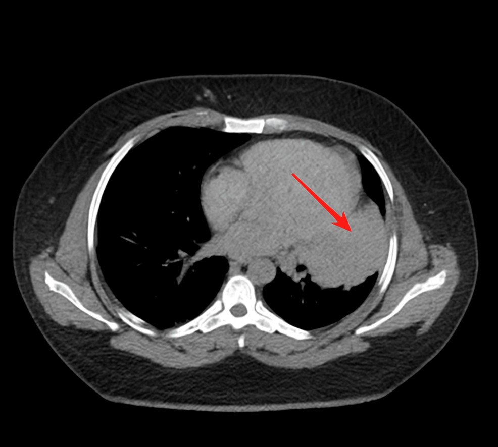 Neoadjuvant Alectinib in a Patient With Anaplastic Lymphoma Kinase (ALK)-Mutant Stage III Lung Adenocarcinoma: A Case Report – Cureus