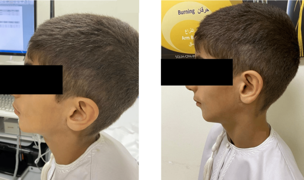 Parry-Romberg Syndrome With Localized Scleroderma: A Report of Two Pediatric Cases From Oman