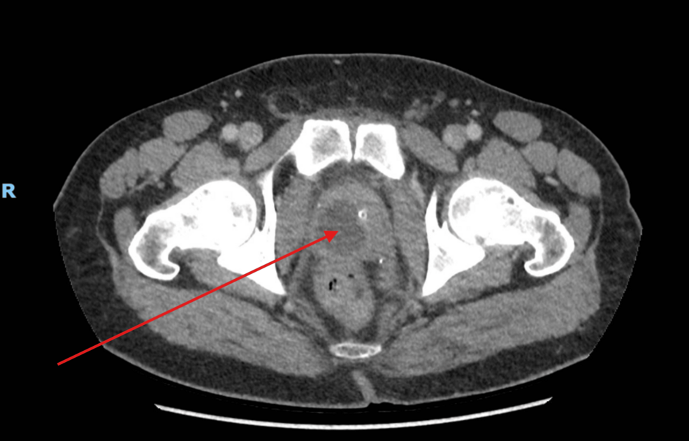 Prostatic Abscess in a 45-Year-Old Male: Atypical Presentation and Successful Management With Open Transperineal Drainage