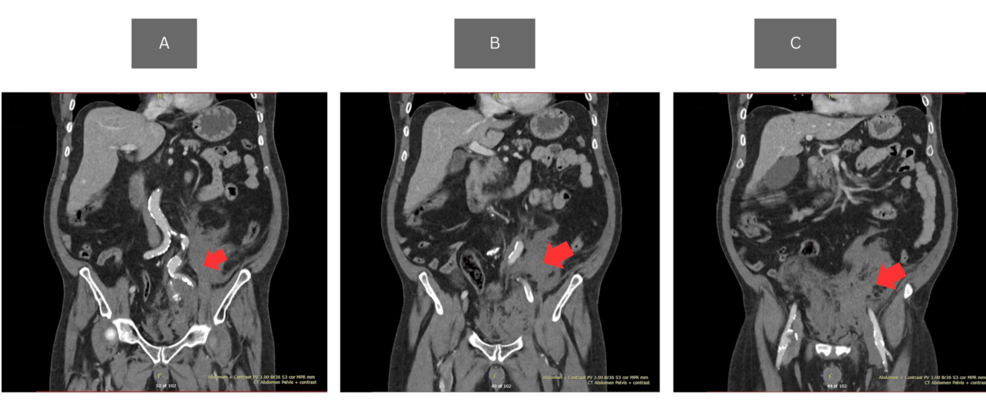 Ruptured Internal Iliac Artery Aneurysm Presenting as Syncope and Left-Sided Abdominal Pain: A Rare Cause of Collapse in the Emergency Department