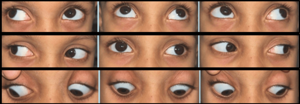 Visual Impairment and Ocular Findings in Children With Developmental Delay Attending a Child Development Unit Clinic at a Tertiary Hospital