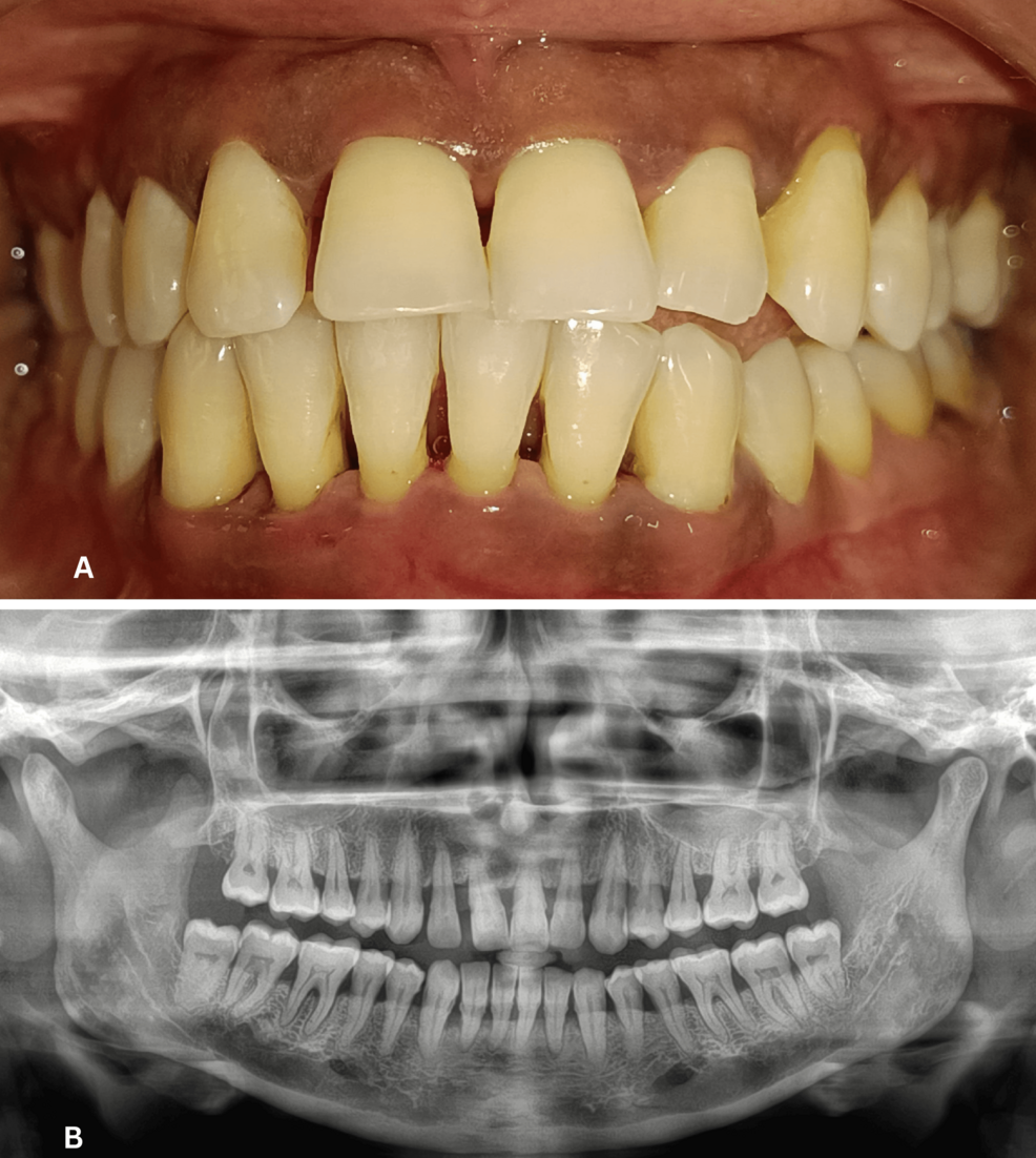Effect of Non-surgical Periodontal Therapy on Levels of Ghrelin and Tumor Necrosis Factor-Alpha (TNF-α) in the Gingival Crevicular Fluid of Healthy and Periodontitis Patients With and Without Type 2 Diabetes Mellitus: A Clinico-Biochemical Study