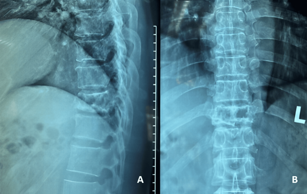 Pathological Fracture of Thoracic Spine Aneurysmal Bone Cyst: A Case With Successful Outcome Following Debulking, Posterior Instrumentation, and Allogenic Bone Impaction Grafting