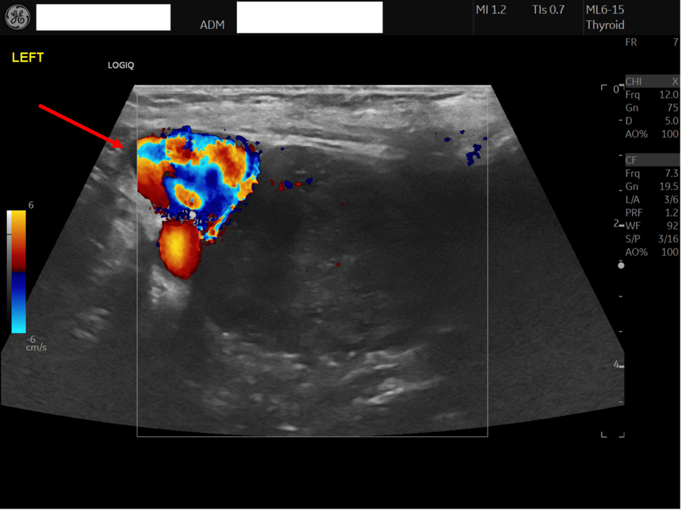 Graves’ Disease in the Elderly: A Case of Fluctuating Hyperthyroidism and Hypothyroidism Resulting in Challenging Management