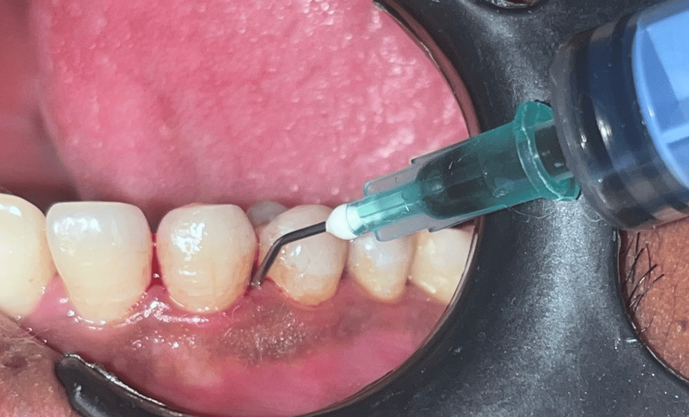 Comparison of the Efficacy of Adjunctive Aids After Scaling and Root Planing in Patients With Chronic Periodontitis