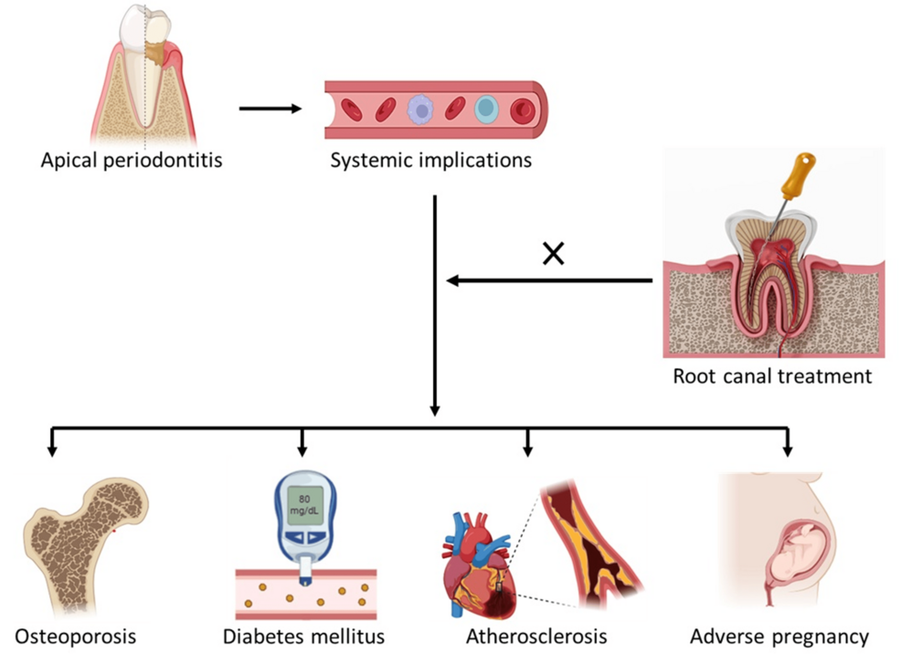Systemic Health Associations of Apical Periodontitis: A Systematic Review of Observational Studies