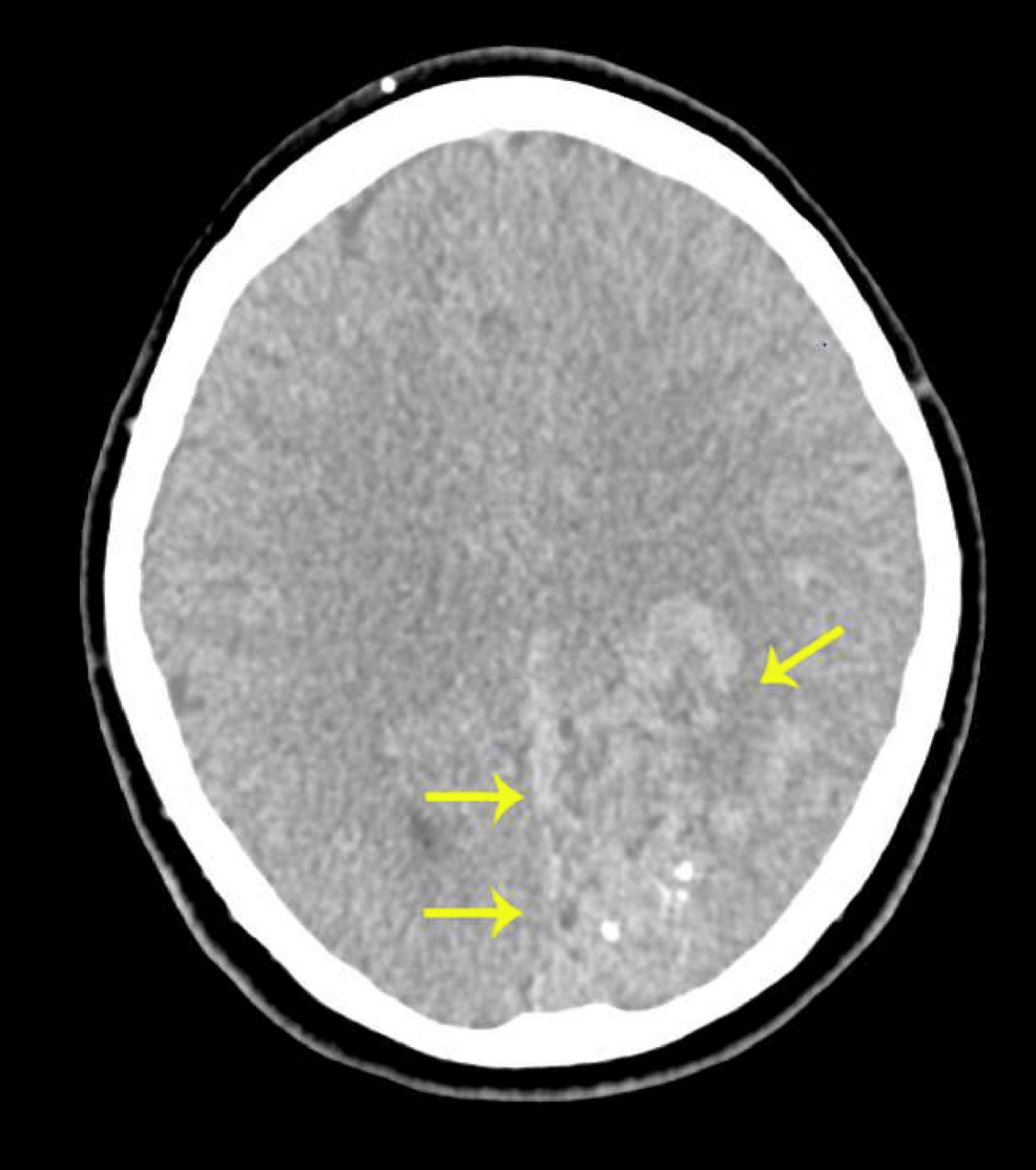 Unmasking a Cerebral Arteriovenous Malformation Presenting as a Chronic Migraine-Type Headache at a District General Hospital