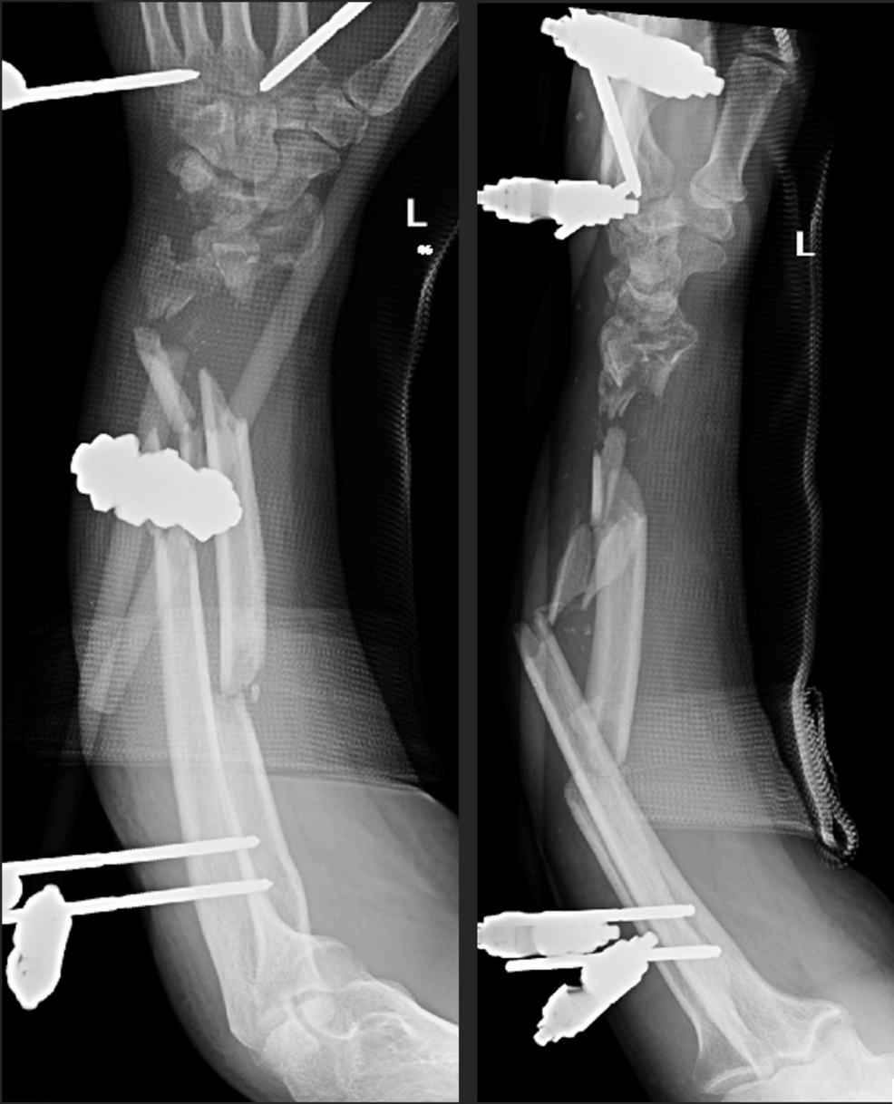Management of an Adult Open Diaphyseal Both-Bone Forearm Fracture With Severe Bone Loss: A Case Report, Literature Review, and Surgical Techniques