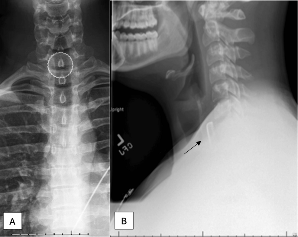 From Beer Pong to the OR: Management of Metallic Bottle Cap Foreign Body Ingestion