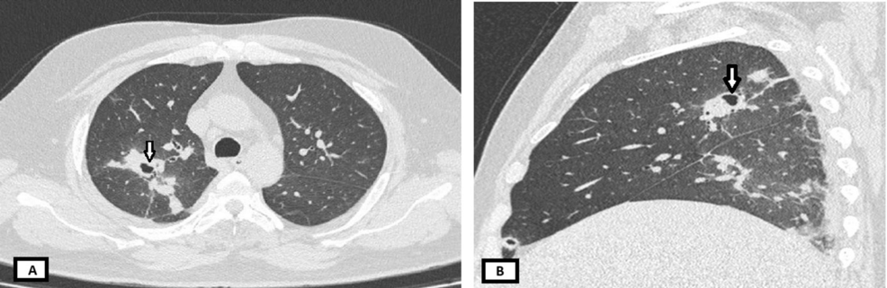 Pulmonary Melioidosis Masquerading As Tuberculosis: A Case Report Presenting a Rare Medical Condition From Western India