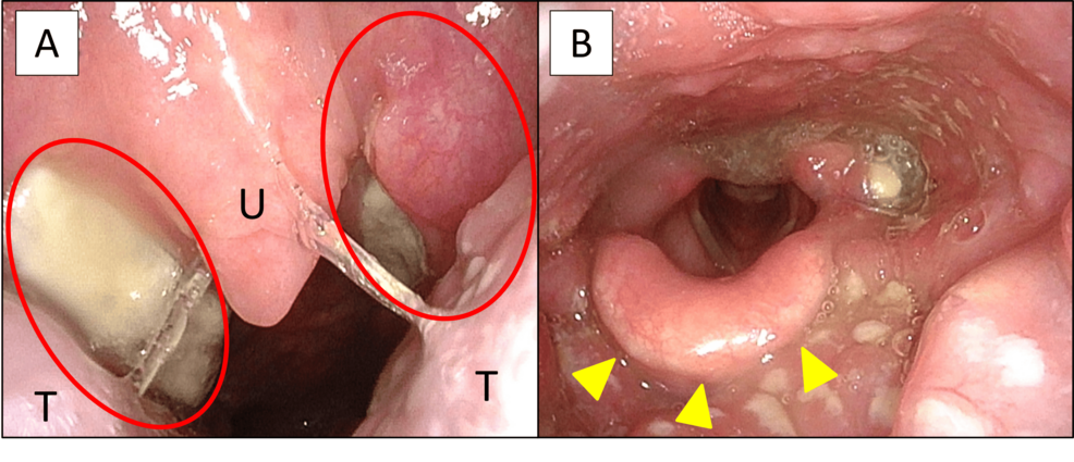 A Case of Infectious Mononucleosis With Peritonsillar Abscess in a Middle-Aged Patient