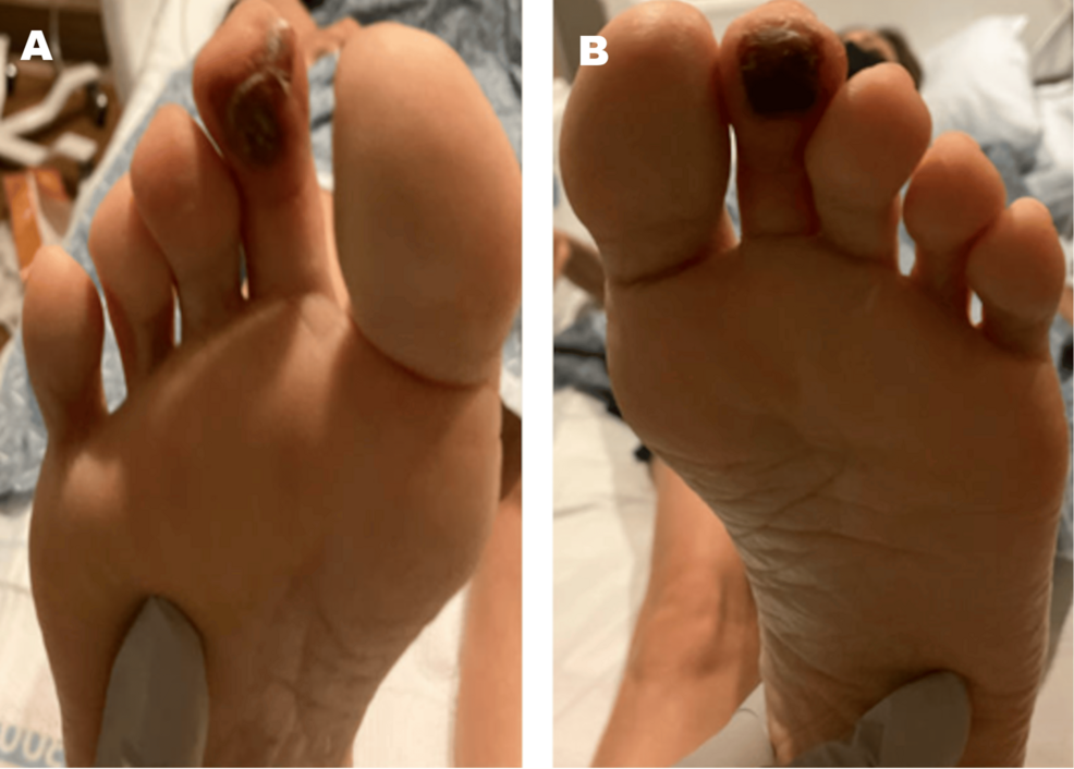 Ischemic Necrosis of Bilateral Second Toes in the Absence of Macrovascular Disease or Primary Vasculitis: A Unique Case of Systemic Sclerosis Sine Scleroderma (ssSSc)