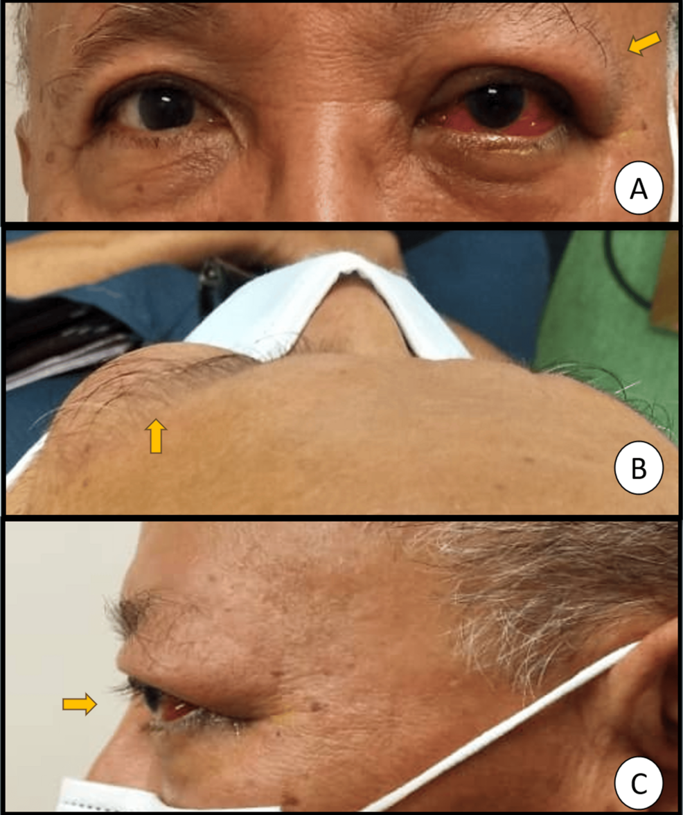 When Postoperative Inflammation Isn’t Benign: Thyroid Eye Disease Following Cataract Surgery