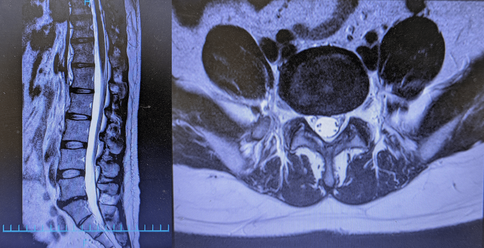 Effectiveness of Ultrasound-Guided Hydrodissection for Atypical Anterior Cutaneous Nerve Entrapment Syndrome Presenting as Lower Back Pain Due to Retrograde Neuropathic Pain