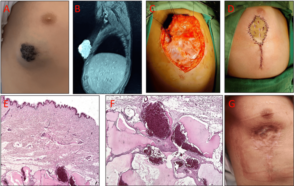 Surgical Management of Pediatric Venous Malformations Misdiagnosed As Infantile Hemangiomas: A Report of Two Cases
