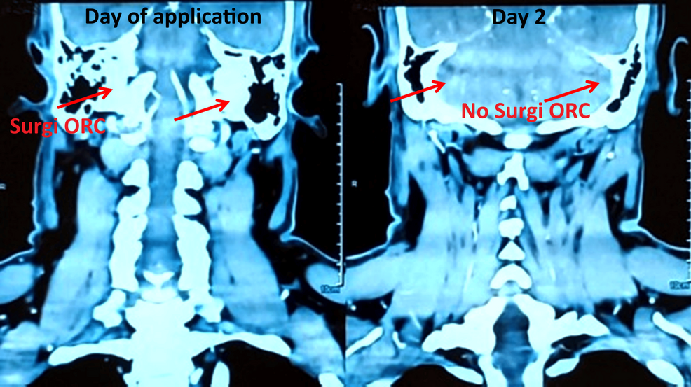 Real-World Case Series on Surgi-ORC® in ENT Surgery
